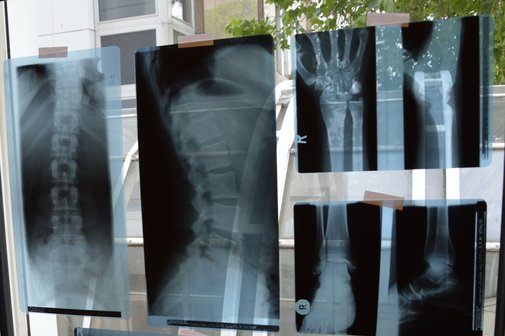 Röntgenaufnahmen einer Wirbelsäule und Hand- und Fußgelenken sind an eine Fensterscheibe geheftet.
