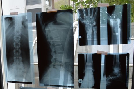 Röntgenaufnahmen einer Wirbelsäule und Hand- und Fußgelenken sind an eine Fensterscheibe geheftet.